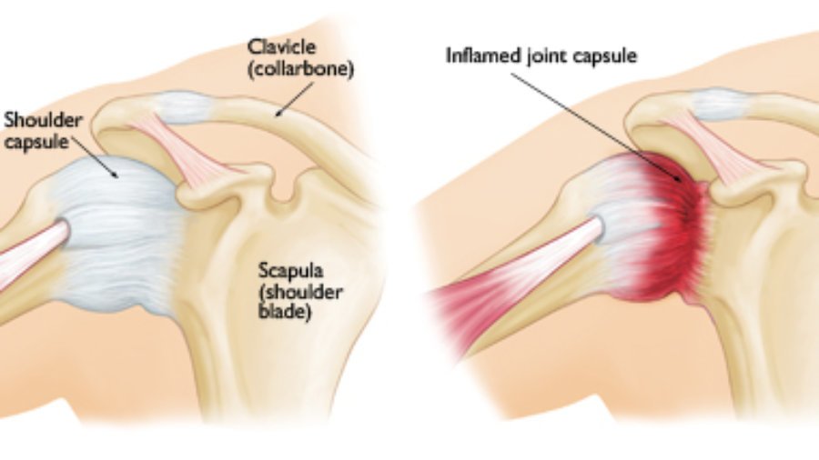 shoulder_capsule_image